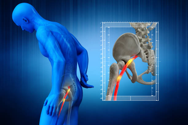 What is the most effective treatment for sciatica?