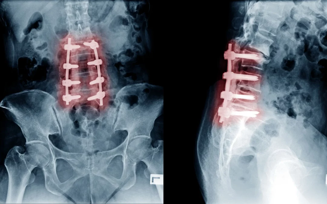 A New Approach to Treating Back Pain and Degenerative Disc Disease
