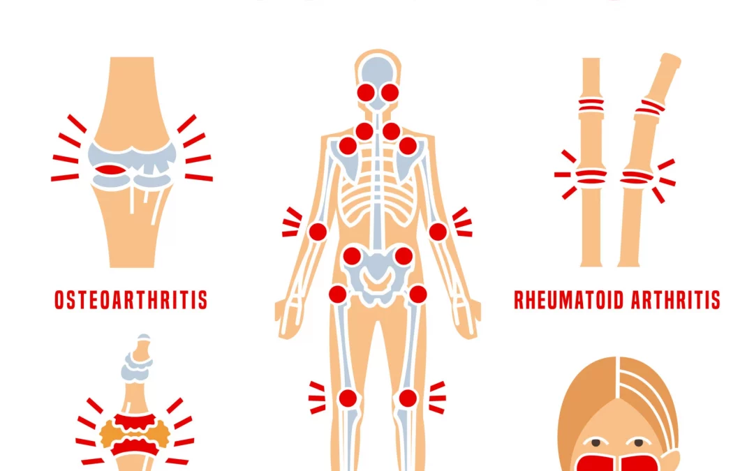 Are There Different Types of Arthritis?